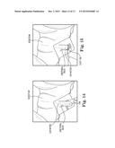 SURGICAL SYSTEM FOR AND A METHOD OF IDENTIFYING AN INCISION SITE diagram and image