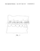 SELF-UPRIGHTING ORTHODONTIC BRACKET ASSEMBLY AND A METHOD OF USING THE     BRACKET ASSEMBLY diagram and image