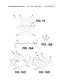 MODULAR INTRAOCULAR LENS DESIGNS AND METHODS diagram and image