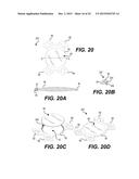 MODULAR INTRAOCULAR LENS DESIGNS AND METHODS diagram and image