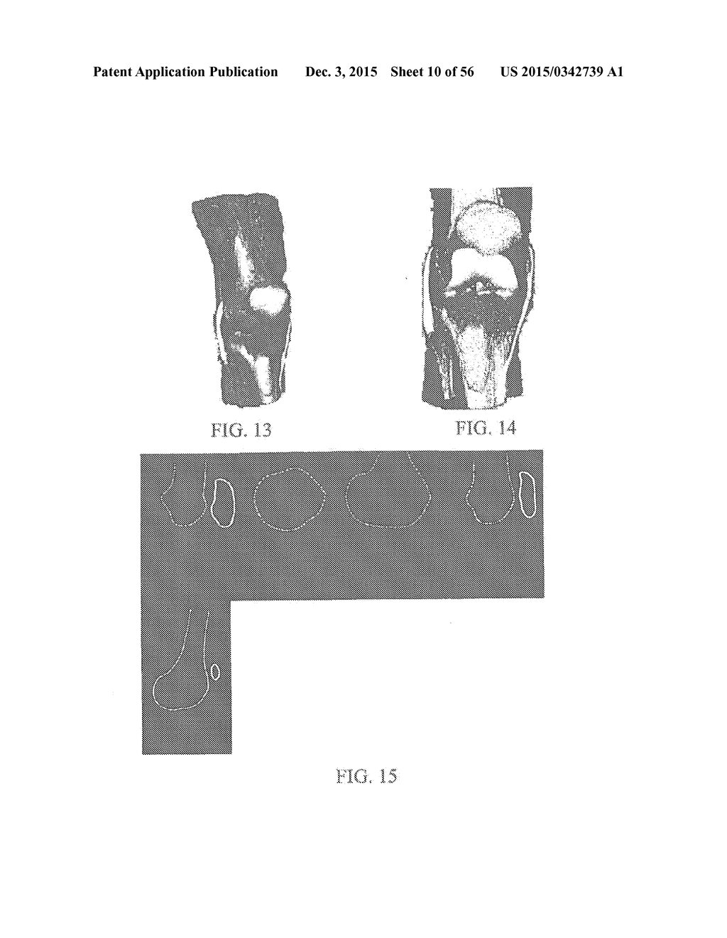 DEFORMABLE ARTICULATING TEMPLATES - diagram, schematic, and image 11