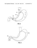 GASTRO-ESOPHAGEAL IMPLANTS diagram and image