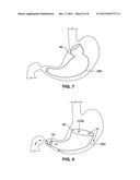 GASTRO-ESOPHAGEAL IMPLANTS diagram and image