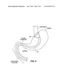 GASTRO-ESOPHAGEAL IMPLANTS diagram and image