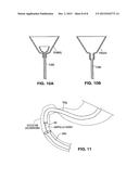 GASTRO-ESOPHAGEAL IMPLANTS diagram and image