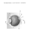 IMPLANTS WITH CONTROLLED DRUG DELIVERY FEATURES AND METHODS OF USING SAME diagram and image