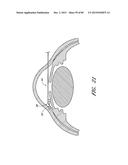 IMPLANTS WITH CONTROLLED DRUG DELIVERY FEATURES AND METHODS OF USING SAME diagram and image