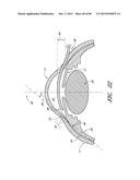 IMPLANTS WITH CONTROLLED DRUG DELIVERY FEATURES AND METHODS OF USING SAME diagram and image