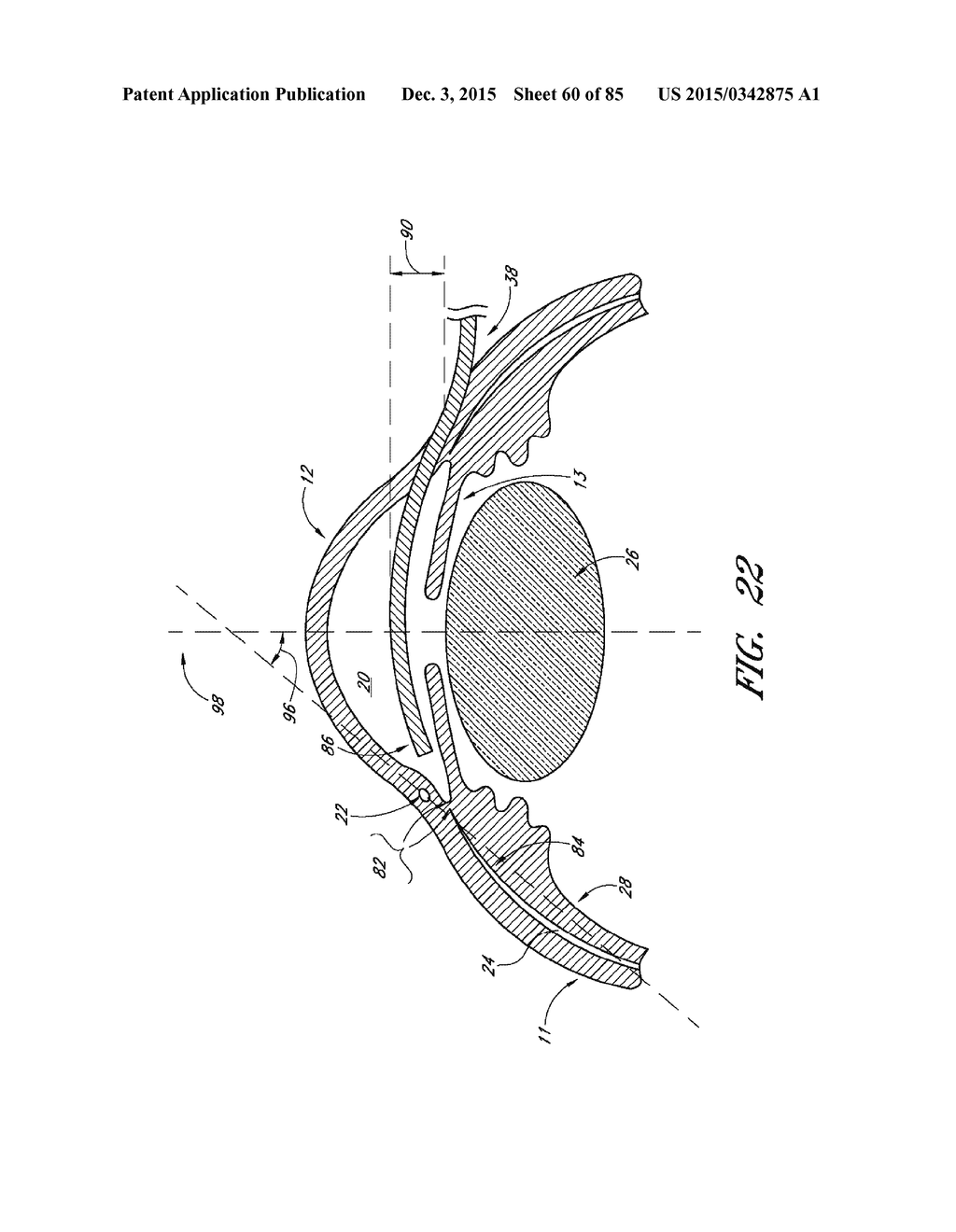 IMPLANTS WITH CONTROLLED DRUG DELIVERY FEATURES AND METHODS OF USING SAME - diagram, schematic, and image 61