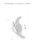 IMPLANTS WITH CONTROLLED DRUG DELIVERY FEATURES AND METHODS OF USING SAME diagram and image