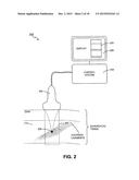 METHOD AND SYSTEM FOR NONINVASIVE MASTOPEXY diagram and image