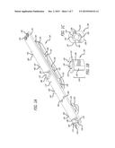 MODULAR REPLACEABLE SLIP JOINT INTERCOSTAL diagram and image