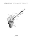 RETROGRADE REAMER DEPTH TUB GAGE diagram and image