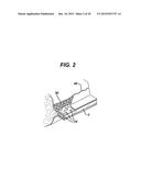 Methods and Devices for Reinforcing a Staple Line diagram and image