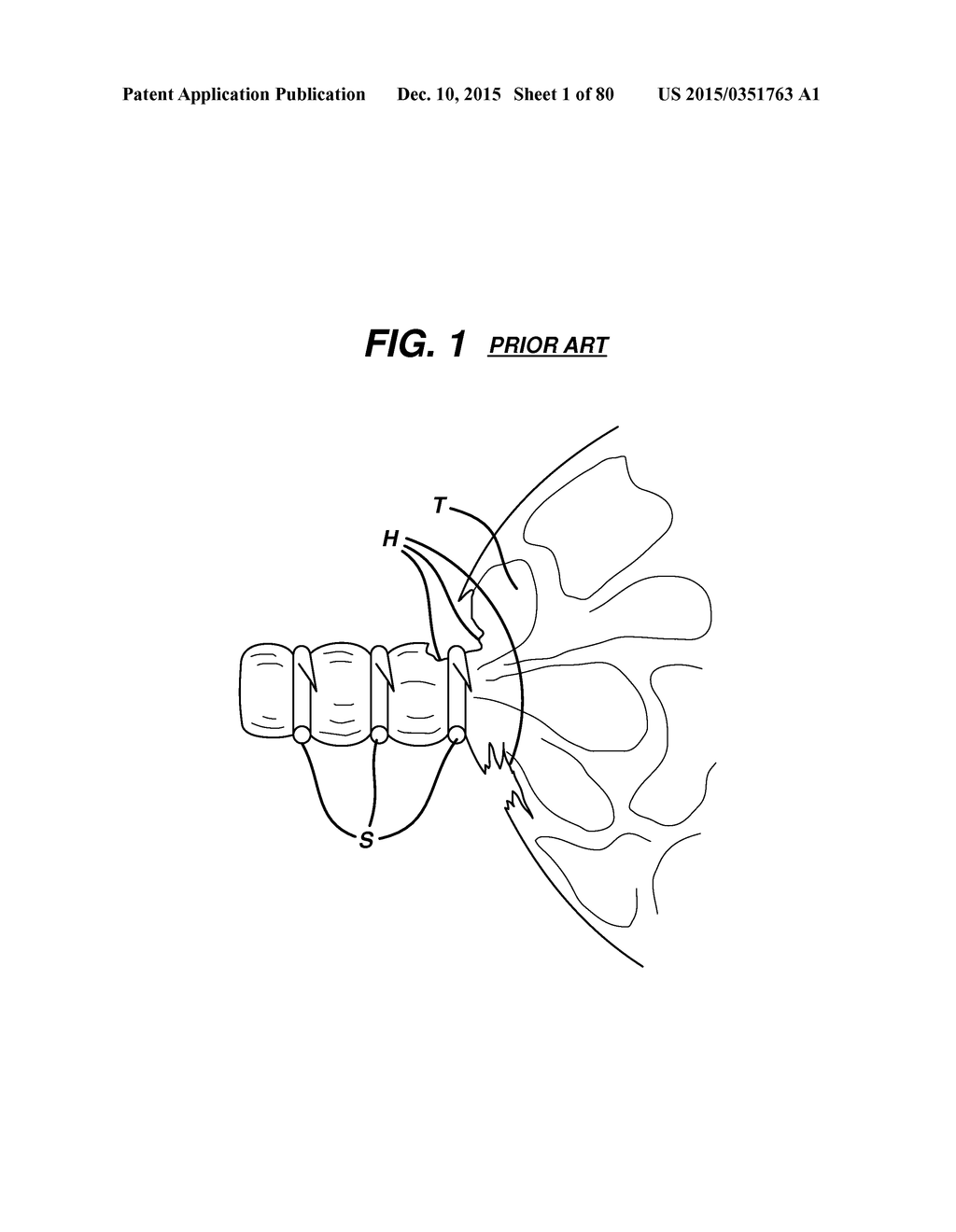 Devices and Methods for Sealing Staples in Tisue - diagram, schematic, and image 02