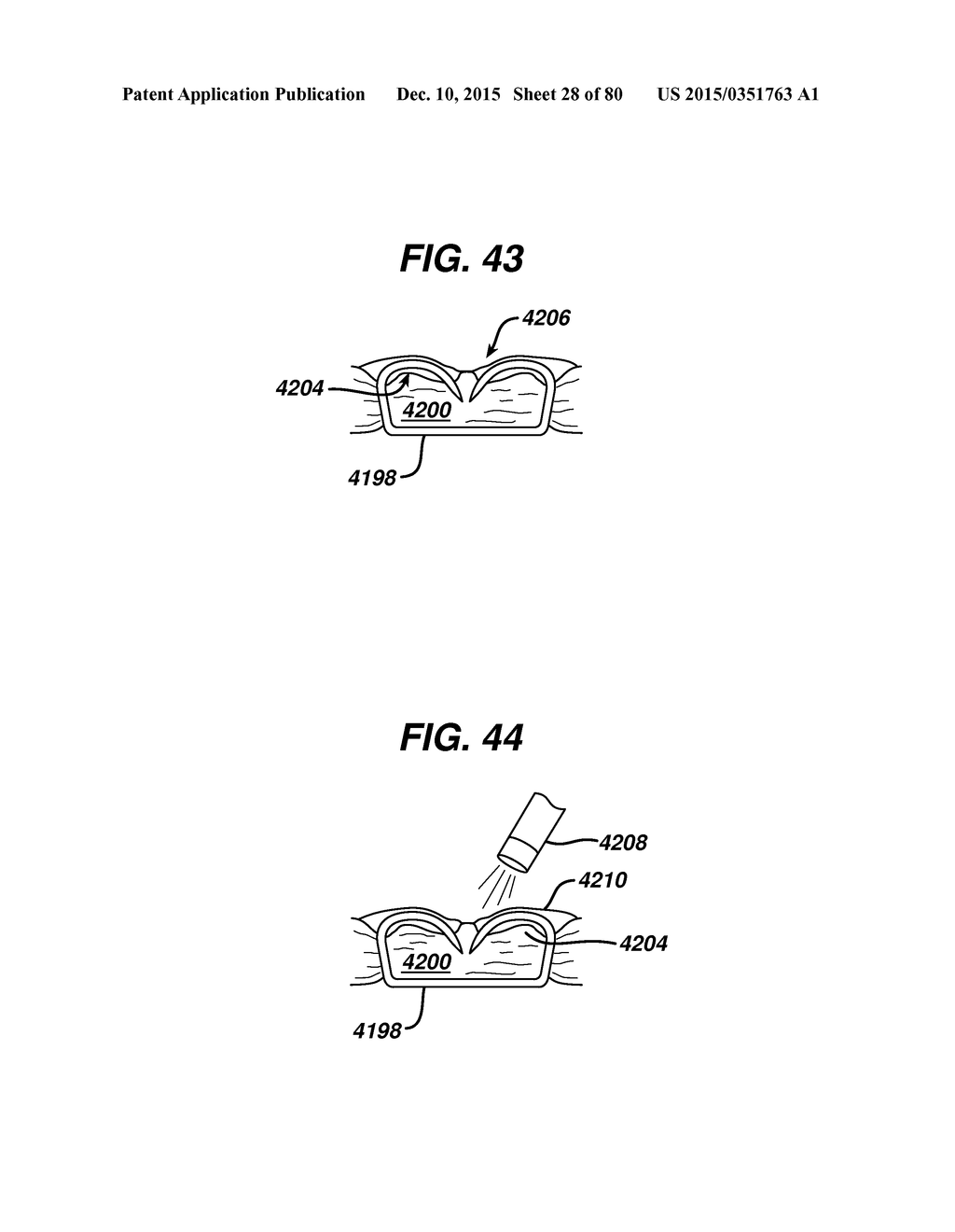 Devices and Methods for Sealing Staples in Tisue - diagram, schematic, and image 29