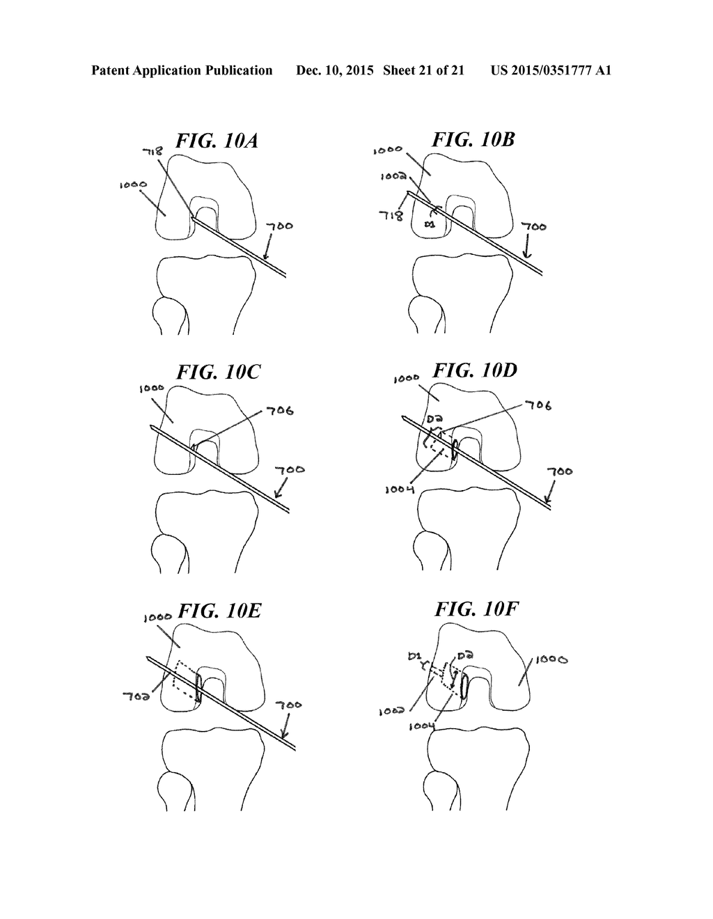 RETRO-CUTTING INSTRUMENT WITH ADJUSTABLE LIMIT SETTING - diagram, schematic, and image 22