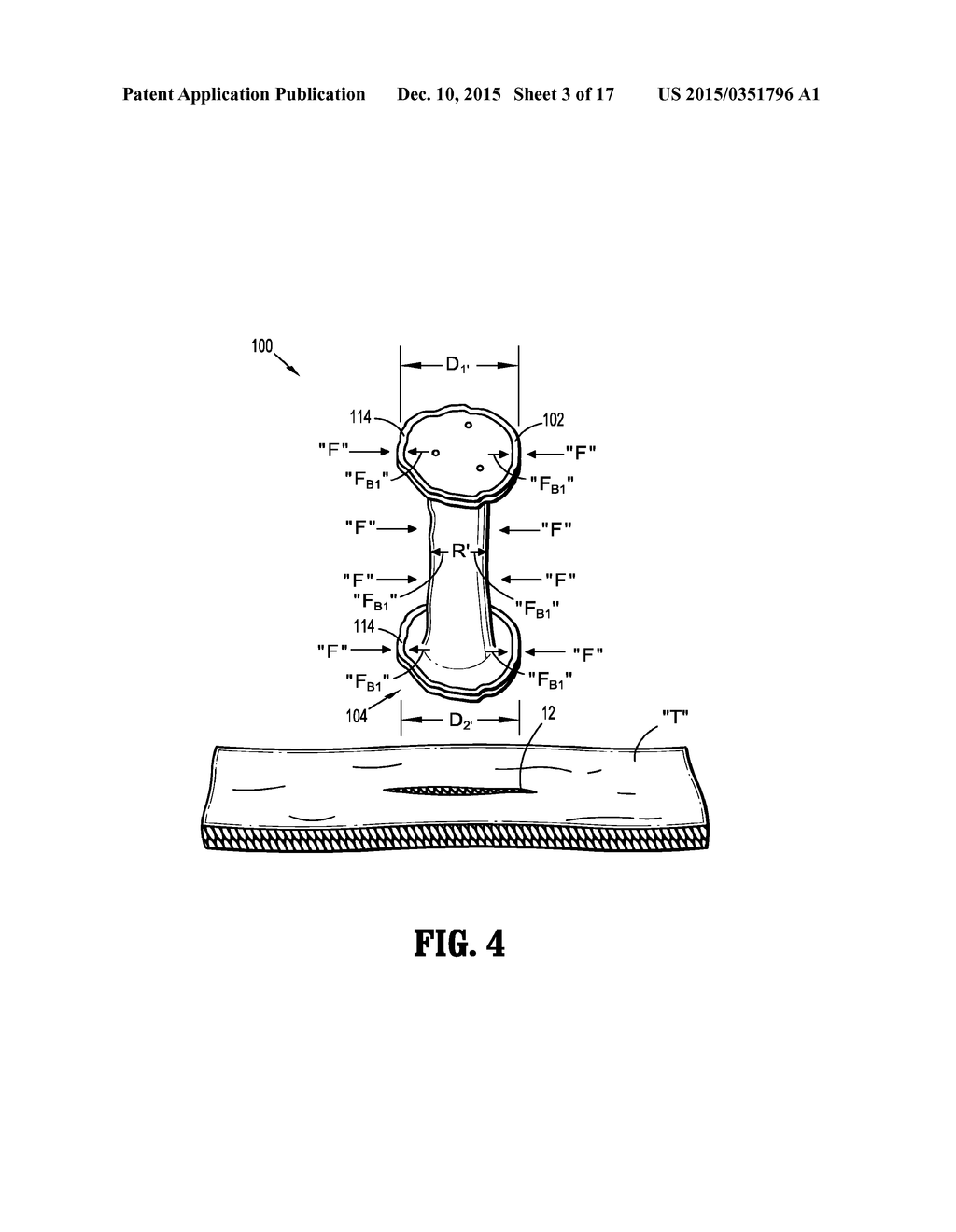 SEAL ANCHOR FOR USE IN SURGICAL PROCEDURES - diagram, schematic, and image 04