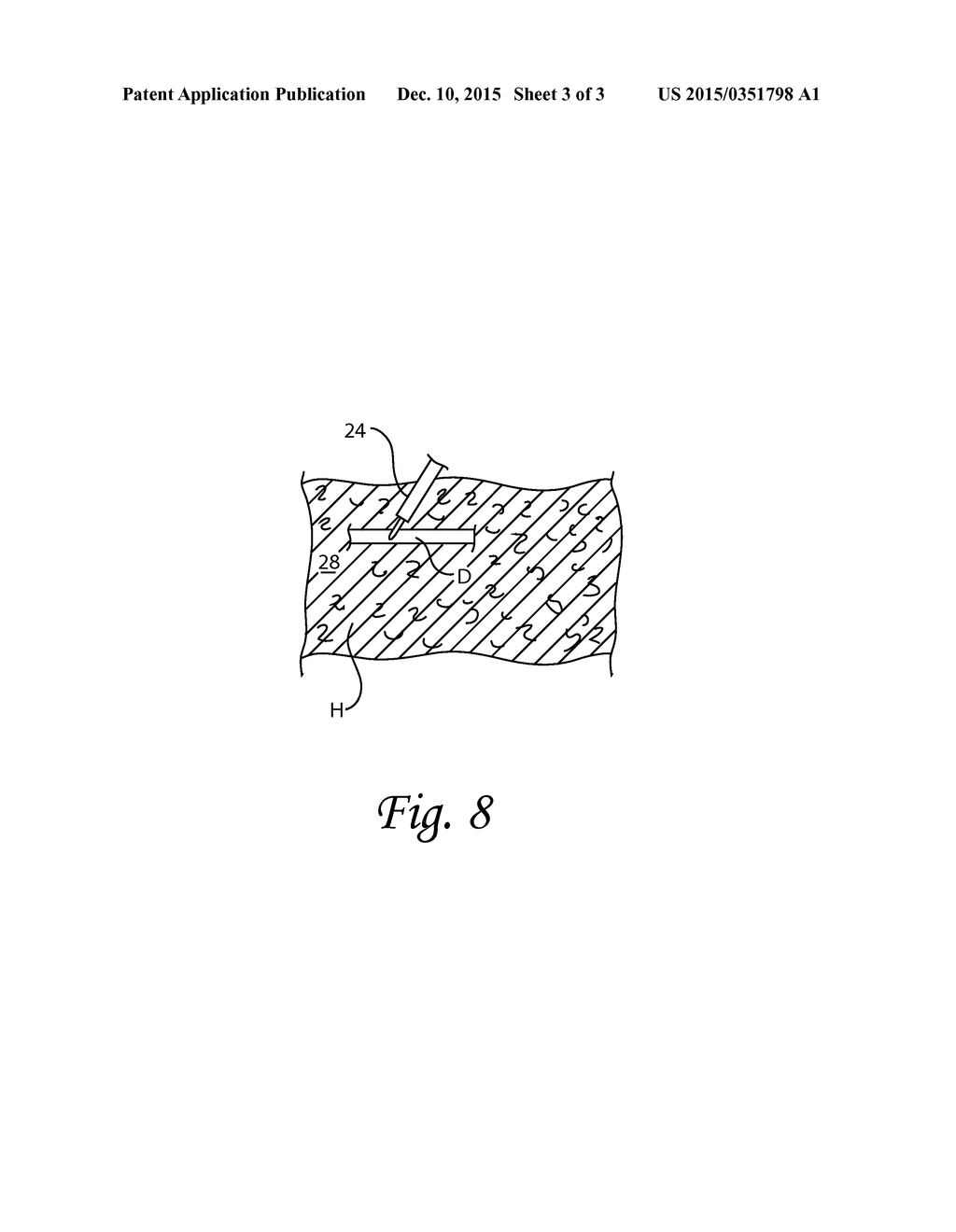 Needle Aponeurotomy Apparatus and Method - diagram, schematic, and image 04