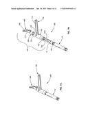 ROD REDUCER, COMPRESSOR, DISTRACTOR SYSTEM diagram and image