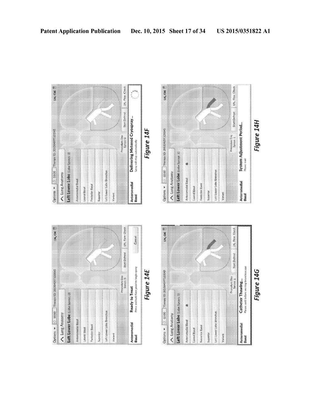 METHOD AND SYSTEM FOR CONSISTENT, REPEATABLE, AND SAFE CRYOSPRAY TREATMENT     OF AIRWAY TISSUE - diagram, schematic, and image 18