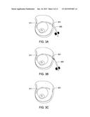 SYSTEMS AND METHODS FOR MASTOPEXY diagram and image