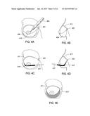 SYSTEMS AND METHODS FOR MASTOPEXY diagram and image