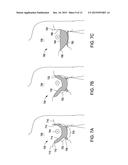 SYSTEMS AND METHODS FOR MASTOPEXY diagram and image