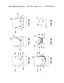 SYSTEMS AND METHODS FOR MASTOPEXY diagram and image