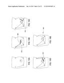 SYSTEMS AND METHODS FOR MASTOPEXY diagram and image