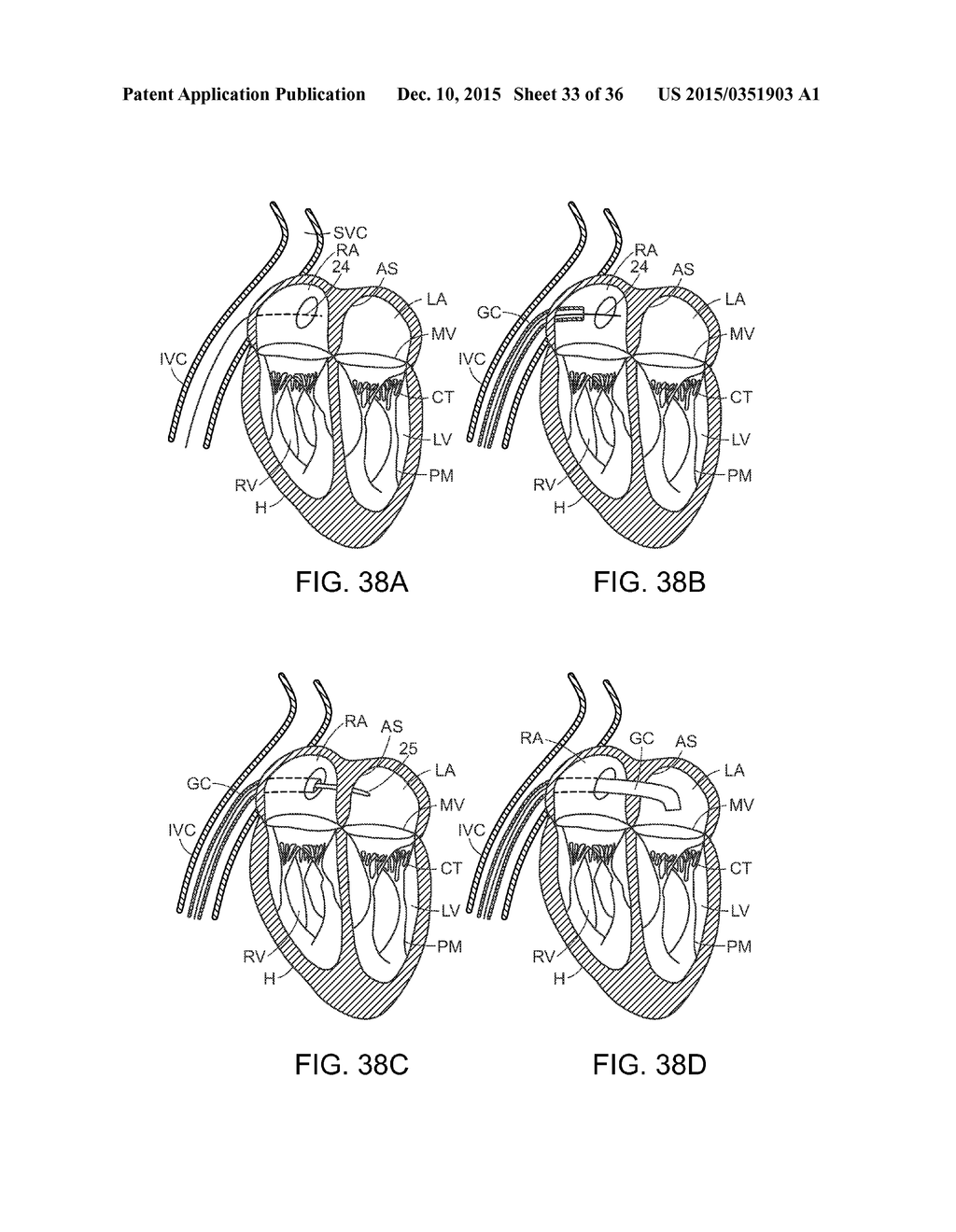 DEVICES, SYSTEMS AND METHODS FOR HEART VALVE REPLACEMENT - diagram, schematic, and image 34