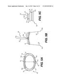 DEVICES FOR REMODELING A VALVE ANNULUS AND VENTRICLE diagram and image