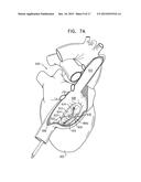 SOFT TISSUE ANCHORS AND IMPLANTATION TECHNIQUES diagram and image