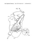 SOFT TISSUE ANCHORS AND IMPLANTATION TECHNIQUES diagram and image