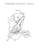 SOFT TISSUE ANCHORS AND IMPLANTATION TECHNIQUES diagram and image