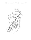 SOFT TISSUE ANCHORS AND IMPLANTATION TECHNIQUES diagram and image