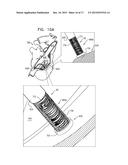 SOFT TISSUE ANCHORS AND IMPLANTATION TECHNIQUES diagram and image