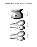 SYSTEM AND METHOD FOR THREE DIMENSIONAL PRINTED IMPLANTATION GUIDES diagram and image