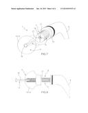 MODULAR SPACER DEVICE FOR THE TREATMENT OF PROSTHESIS INFECTIONS diagram and image