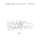 PIVOTABLE INTERBODY IMPLANT SYSTEM diagram and image