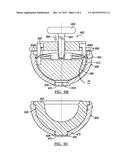 Separation of hip joint liner and socket elements diagram and image