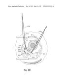 THERAPEUTIC AGENT DELIVERY DEVICE WITH CONVERGENT LUMEN diagram and image