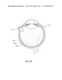 THERAPEUTIC AGENT DELIVERY DEVICE WITH CONVERGENT LUMEN diagram and image