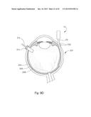 THERAPEUTIC AGENT DELIVERY DEVICE WITH CONVERGENT LUMEN diagram and image