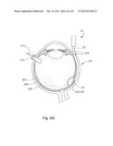 THERAPEUTIC AGENT DELIVERY DEVICE WITH CONVERGENT LUMEN diagram and image