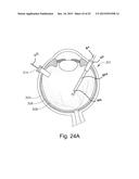 THERAPEUTIC AGENT DELIVERY DEVICE WITH CONVERGENT LUMEN diagram and image