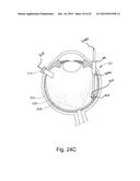 THERAPEUTIC AGENT DELIVERY DEVICE WITH CONVERGENT LUMEN diagram and image