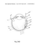 THERAPEUTIC AGENT DELIVERY DEVICE WITH CONVERGENT LUMEN diagram and image