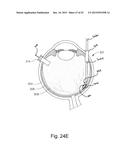 THERAPEUTIC AGENT DELIVERY DEVICE WITH CONVERGENT LUMEN diagram and image