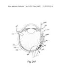 THERAPEUTIC AGENT DELIVERY DEVICE WITH CONVERGENT LUMEN diagram and image